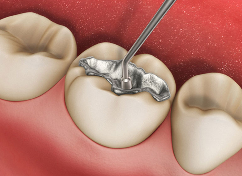 Zahnfüllungen - Zahnarzt Dr. Bischof