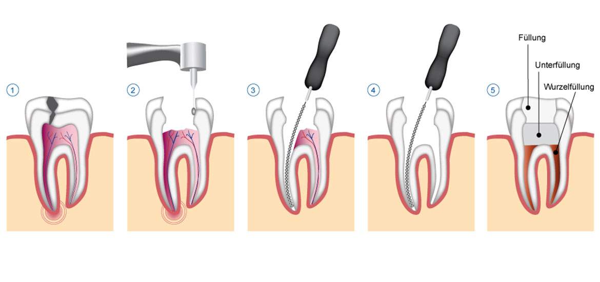 Wurzelbehandlung 2 Sitzung Ohne Betäubung
